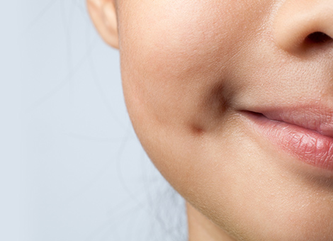 raised acne scar treatment