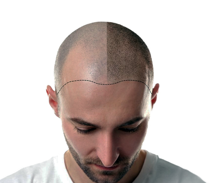 raised acne scar treatment